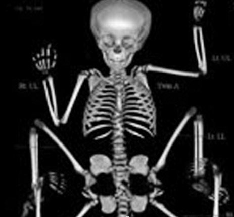 印度女童长有4手4足 被当作女神朝拜(图)