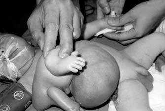 新生男婴长有四条腿两个生殖器(图)