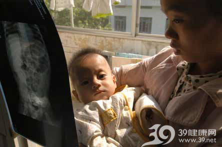 8月男婴腹中冒出3根缝纫针 经两次手术取出(图)