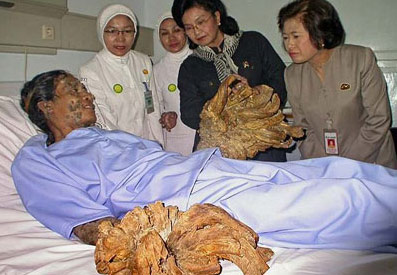 印尼指责国外医生采集半树人病毒样本谋暴利