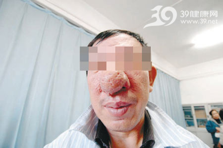 男子酒糟鼻大如高尔夫球 沈阳求医终见曙光(图)