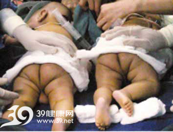 医院公布连体儿分体手术录像 兄弟血肉相连