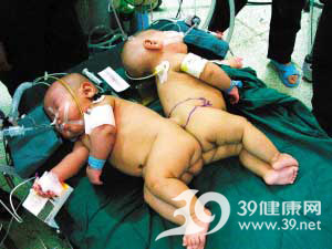 医院公布连体儿分体手术录像 兄弟血肉相连