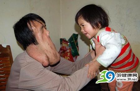 广西“象面人”渴望回归正常生活(图)