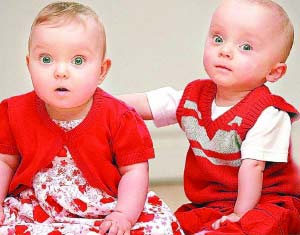 “大小双胞胎”存活 出生时体重差1倍