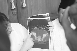 40岁女子怪病缠身17年 皮肤不断长出金属丝(图)