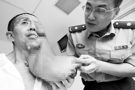 男子脸部长15斤巨瘤40年 手术切除或可恢复面容