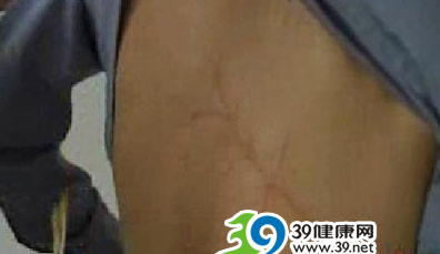 男子听耳机睡觉被雷击 右耳被击穿