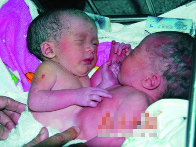 孕妇剖腹产下连体女婴 共用一副肝脏(图)