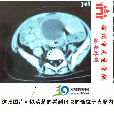 三鹿奶粉在患儿肠道中的影像