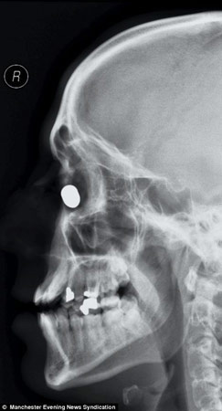 英国男子头部中枪后子弹卡在鼻骨幸存(图)