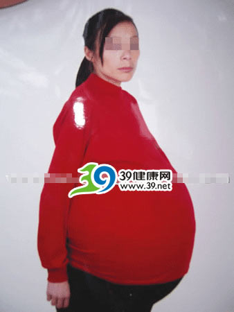 惊!农妇腹中巨型肿瘤