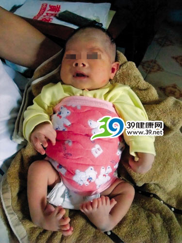 天生八个脚趾的男婴