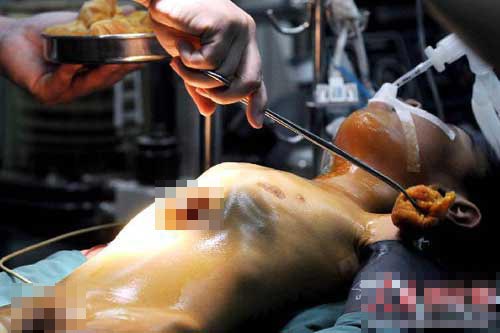 5岁男孩心脏长肚子上 全世界不超过100例(图)