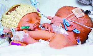 英国连体婴儿分离手术失败