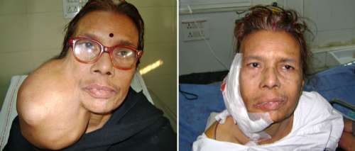 印度一妇女面部肿瘤大如足球 重近2公斤(图)