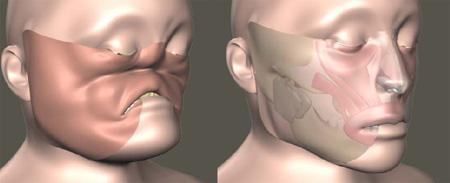 全球首例接近完整换脸手术获成功(图)