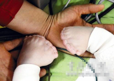 男婴手脚相加29个指 专家称可能是世界之最(图)