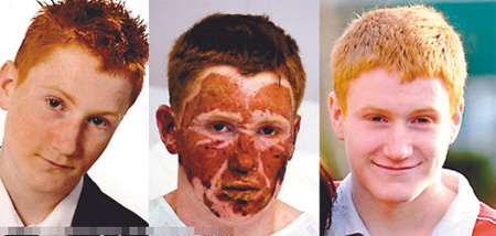 英国雀斑男孩遭毁容后自行长出光洁皮肤(图)