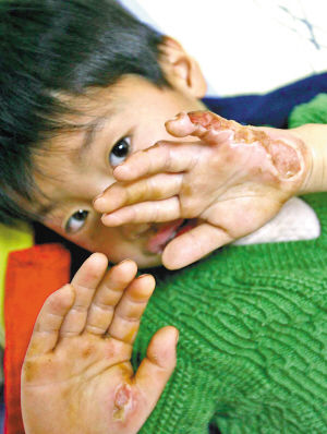 7岁男孩被万伏高压电击倒后奇迹生还(图)