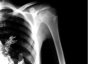 俄罗斯男子肺部长出树苗 医生疑吸入种子所致