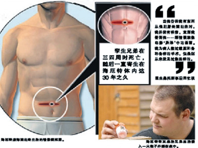 孪生死胎藏匿兄腹30年破脐而出 如“异形”再现