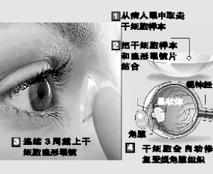 干细胞隐形眼镜21天助盲人复明