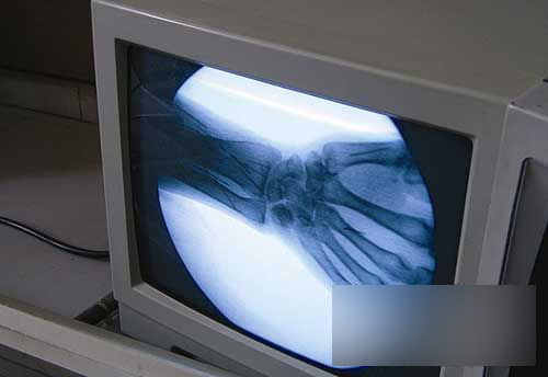 男子体内惊现百余绣花针 注入原因无人知晓