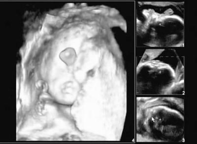 近半打工妹不做产前检查 怀上畸形胎儿(图)