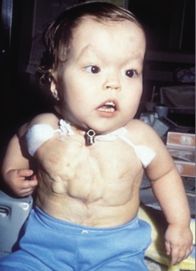 组图:美一男子心脏挂体外存活 将庆祝34岁生日