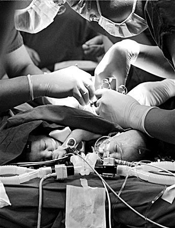 连体女婴出生12天成功分身(组图)