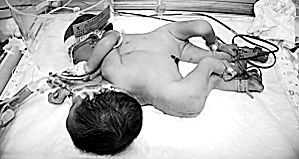 连体女婴出生12天成功分身(组图)