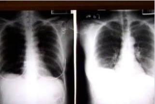 台甲流重症病患靠叶克膜奇迹痊愈