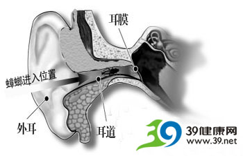 蟑螂钻进耳朵 男子险失聪