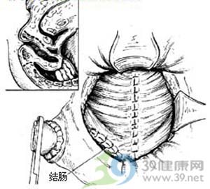 研究发现西妥昔单抗可治疗直肠癌