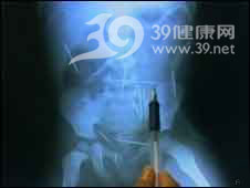 巴西男孩体内发现50支缝衣针 疑遭蓄意伤害(图)