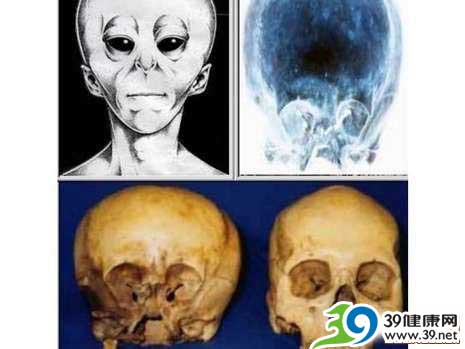 墨西哥怪异头骨引猜测 疑是外星人和地球人混血