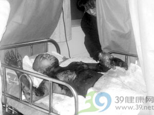 少女闻汽油上瘾 上半身被烧焦(图)