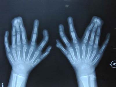 5岁男孩天生31根手指脚趾 破世界纪录(组图)