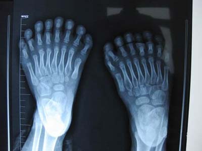 5岁男孩天生31根手指脚趾 破世界纪录(组图)