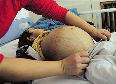男孩罕见病:腹如篮球下身肿胀