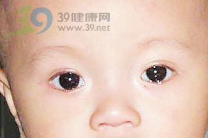 近期福州红眼病患儿增多 家长应重视