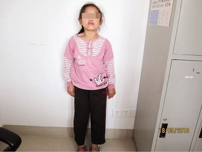 少女身患两种罕见病17岁貌似7岁