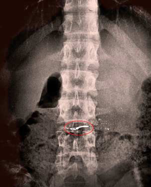 黑新闻：惊！男生吃达利园蛋糕竟吃进水银