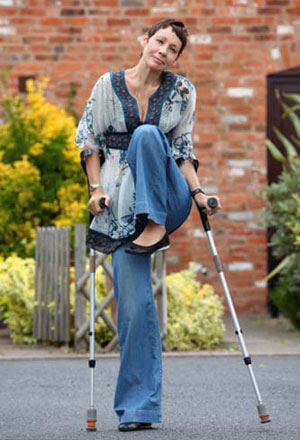 英国妇女患怪病 左腿蜷缩只能单腿站立