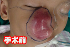 3岁男童面部突现肿瘤 2个月疯长成“拳头”