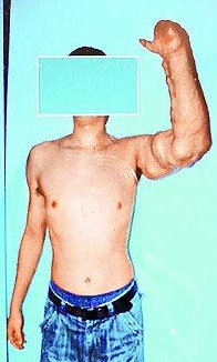 男子手臂长瘤肿如绿巨人 压迫会喷出大量血液