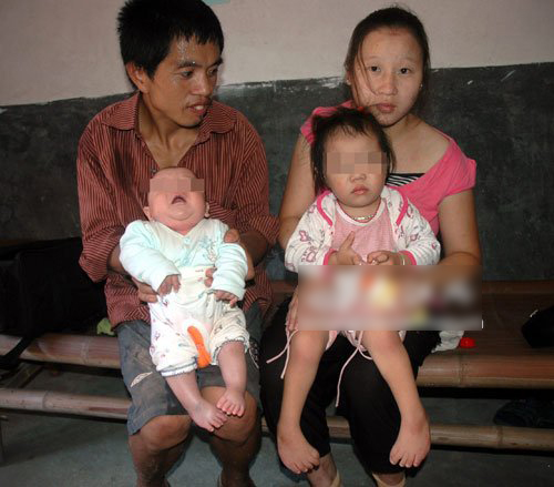 江西鹰潭两姐弟长罕见“芭蕾脚” 父母几近绝望