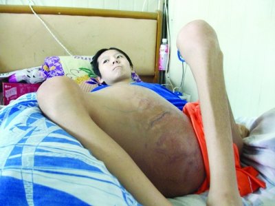 男孩患骨癌后大腿粗如磨盘 已占体重一半以上