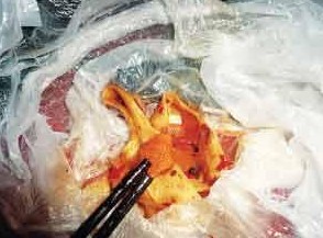 顾客餐厅吃鱼吃出用过创可贴 饭店拒绝顾客要求